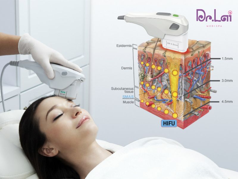 Tại sao nên chọn trẻ hóa da HIFU tại Phòng khám da liễu Dr Lai?