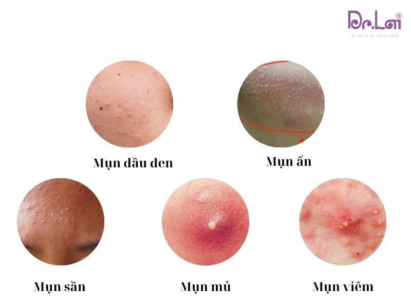 Các loại mụn cần điều trị chuyên sâu
