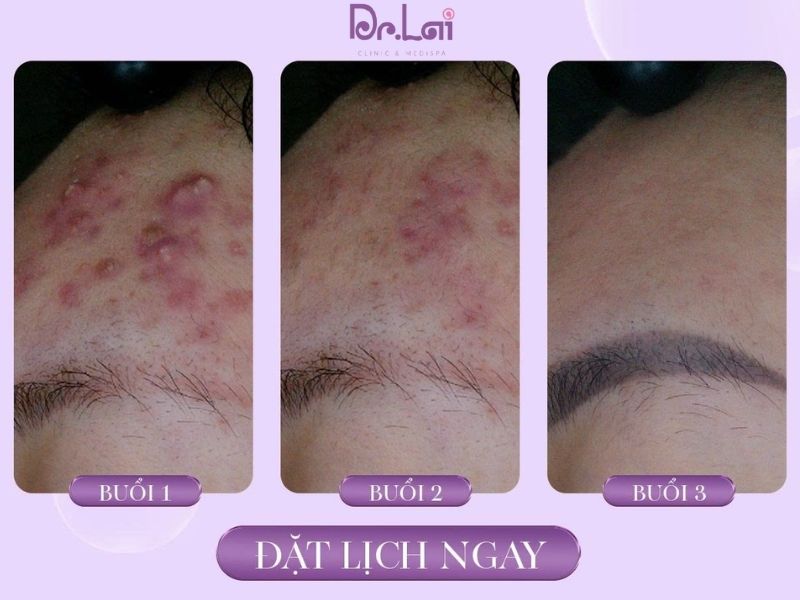 Điều trị mụn chuyên sâu: Phương pháp và phác đồ chuẩn da liễu