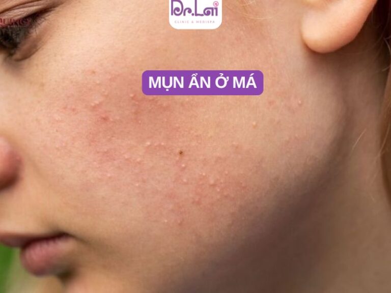 Mụn ẩn ở má