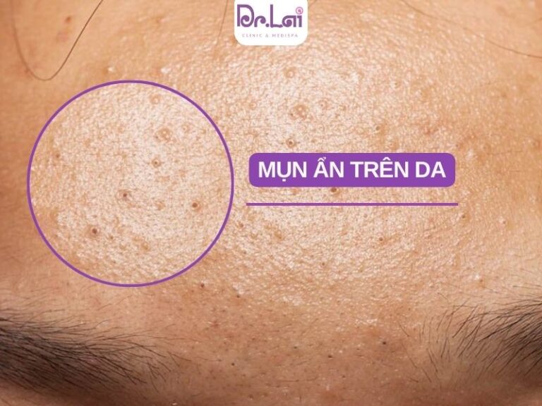 Nguyên nhân gây mụn ẩn phổ biến