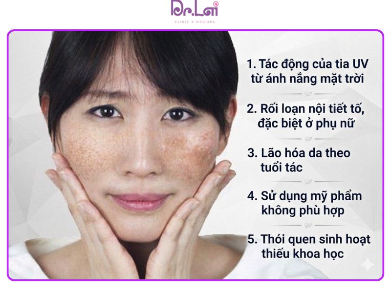 nguyên nhân bị nám tàn nhang