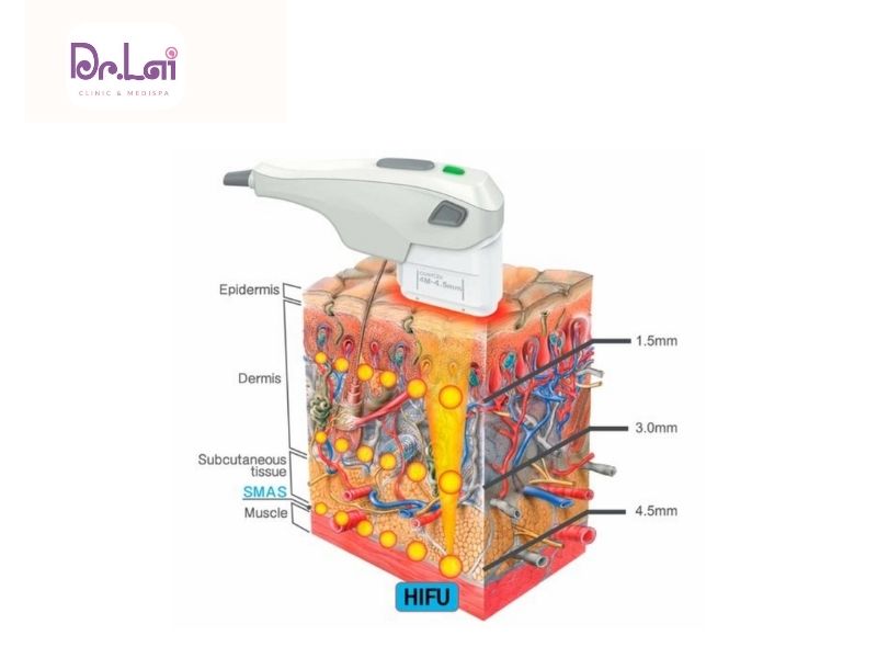 HIFU hoạt động như thế nào?