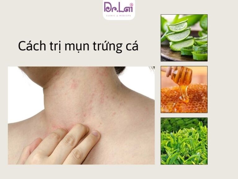vùng cổ dễ xuất hiện mụn trứng cá
