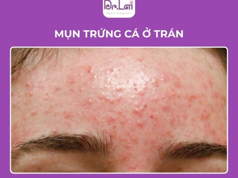 mụn trứng cá thường xuất hiện ở vùng trán